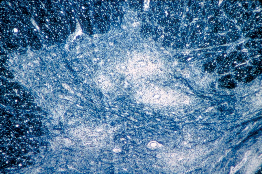 Microscope image of human spinal cord tissue damaged by the poliovirus