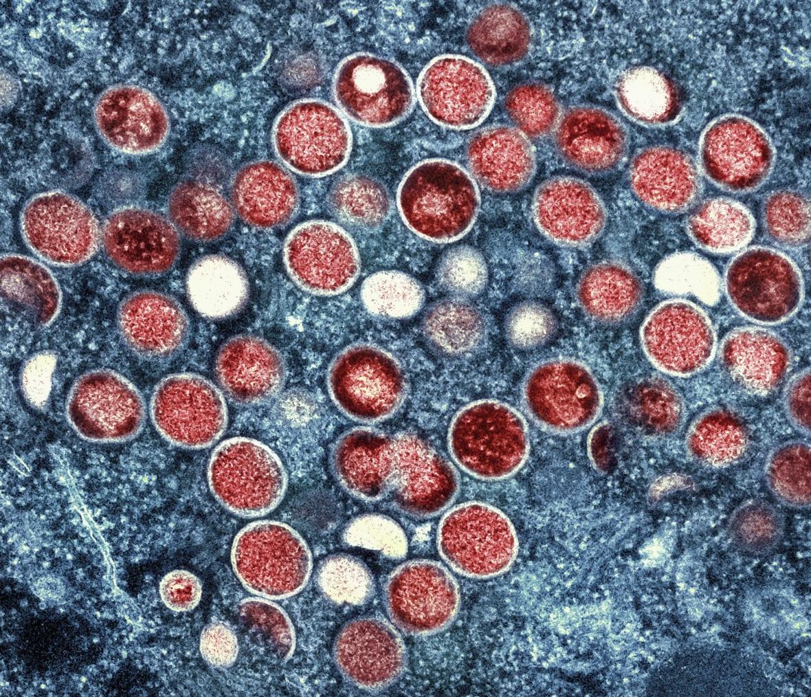 A colorized transmission electron micrograph of Mpox particles