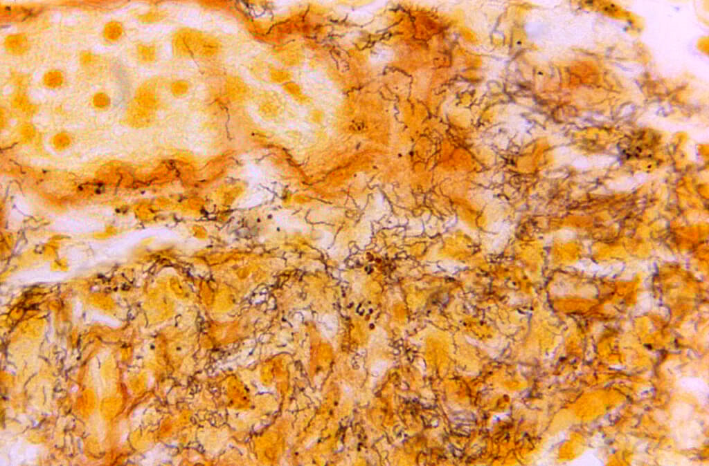 A microscope photo shows a tissue sample with numerous, corkscrew-shaped bacterium responsible for causing syphilis
