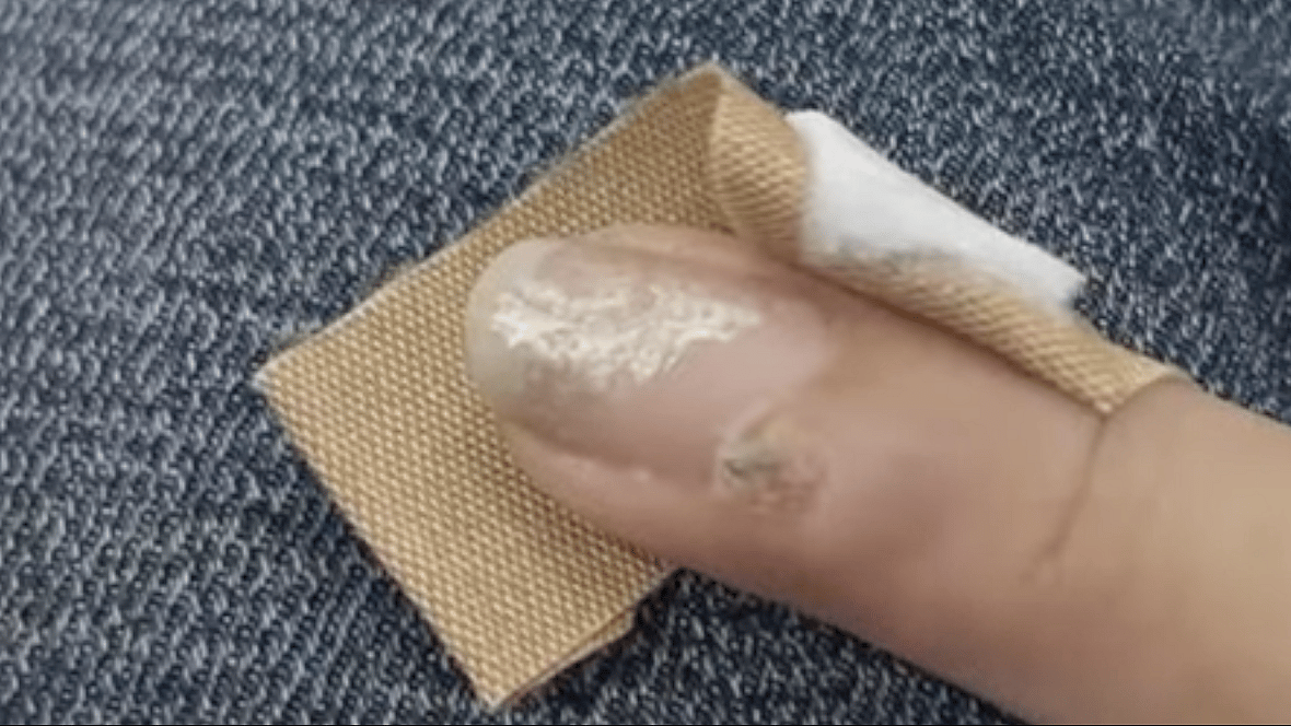 HPV nail cancer Grace Garcia