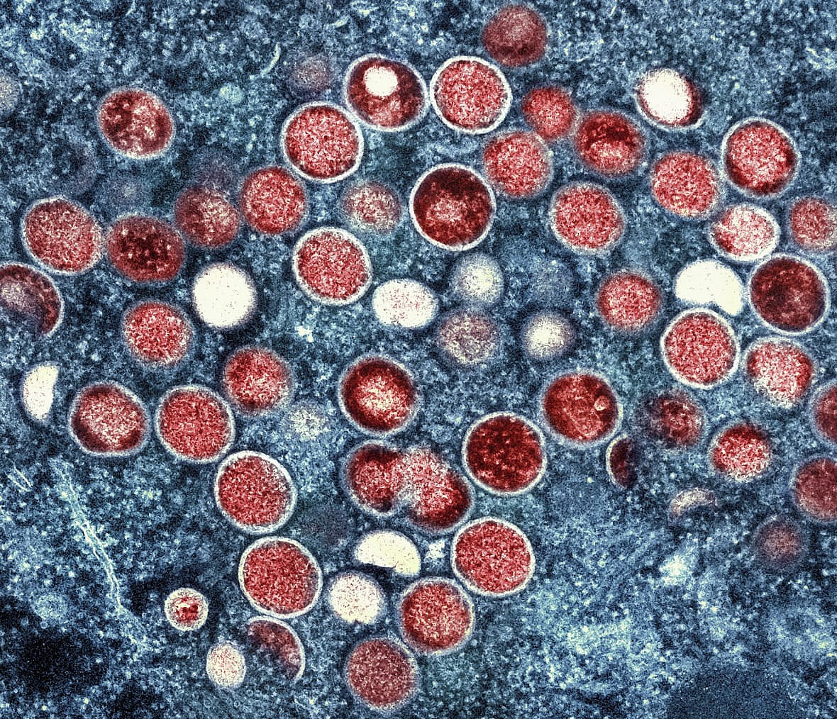 A colorized transmission electron micrograph of Mpox particles