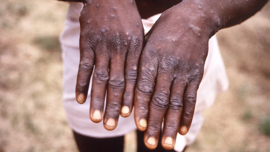 Congo mpox, theGrio.com