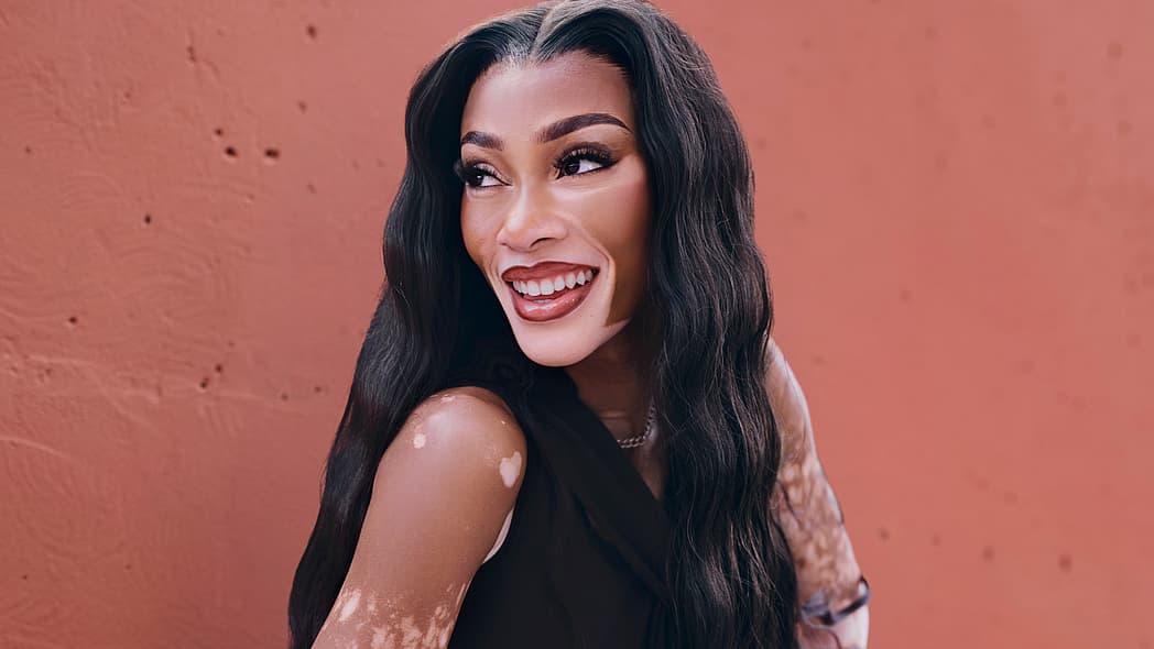 Winnie Harlow, Winnie Harlow vitiligo, Winnie Harlow skin, what is vitiligo? theGrio.com