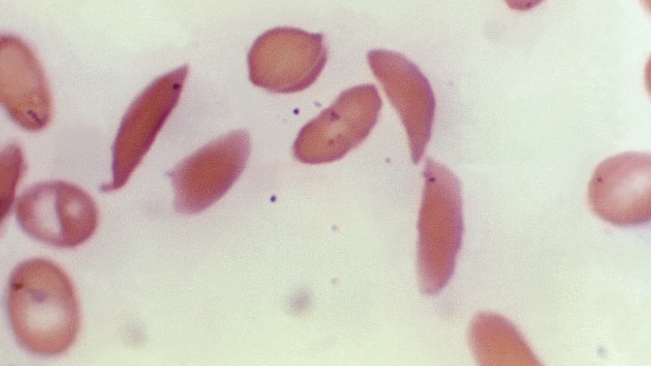 Microscope photo of crescent-shaped red blood cells from a sickle cell disease patient
