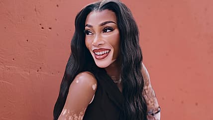Winnie Harlow, Winnie Harlow vitiligo, Winnie Harlow skin, what is vitiligo? theGrio.com