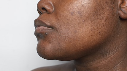 Hyperpigmentation, Melasyl, L'Oréal, Black skincare, Black skincare needs, Black dermatologists, Black health and wellness, theGrio.com