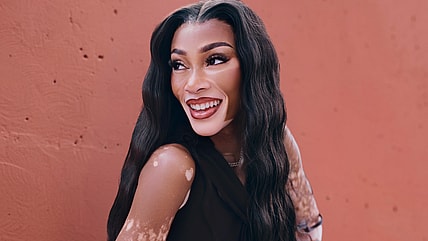 Winnie Harlow, Winnie Harlow vitiligo, Winnie Harlow skin, what is vitiligo? theGrio.com