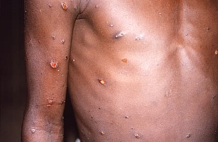 Monkeypox in dog