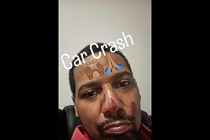 Juelz Santana Instagram story revealing injured face