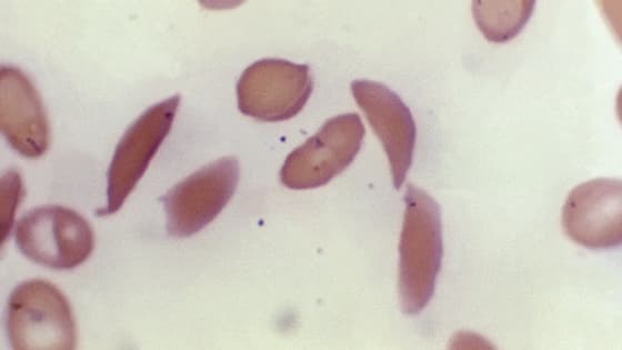 This microscope photo provided on Oct. 25, 2023, by the Centers for Disease Control and Prevention shows crescent-shaped red blood cells from a sickle cell disease patient in 1972. (Dr. F. Gilbert/CDC via AP, File ) theGrio.com