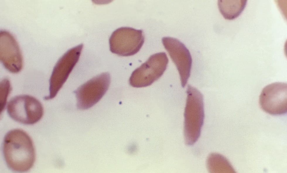 This microscope photo provided on Oct. 25, 2023, by the Centers for Disease Control and Prevention shows crescent-shaped red blood cells from a sickle cell disease patient in 1972. (Dr. F. Gilbert/CDC via AP, File ) theGrio.com