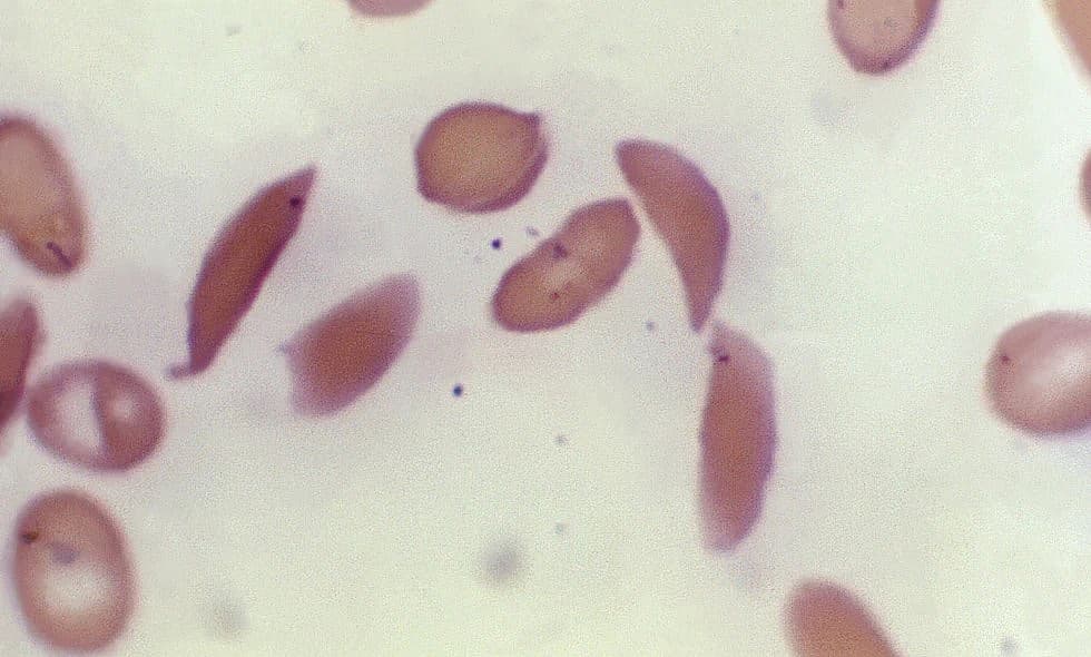 This microscope photo provided on Oct. 25, 2023, by the Centers for Disease Control and Prevention shows crescent-shaped red blood cells from a sickle cell disease patient in 1972. (Dr. F. Gilbert/CDC via AP, File ) theGrio.com