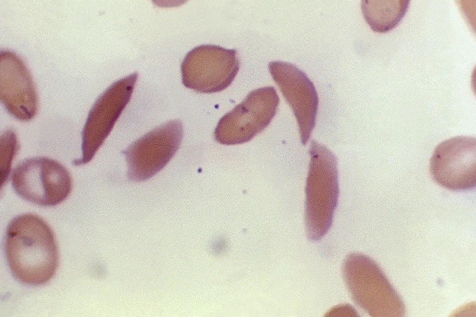 This microscope photo provided on Oct. 25, 2023, by the Centers for Disease Control and Prevention shows crescent-shaped red blood cells from a sickle cell disease patient in 1972. (Dr. F. Gilbert/CDC via AP, File ) theGrio.com