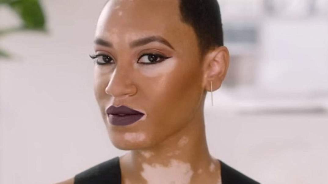 Amy Deanna becomes CoverGirl's first model with vitiligo. (CoverGirl) thegrio.com