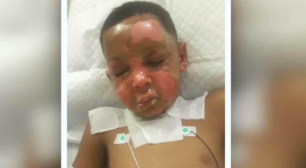 Houston boy set on fire by neighbor's child thegrio.com