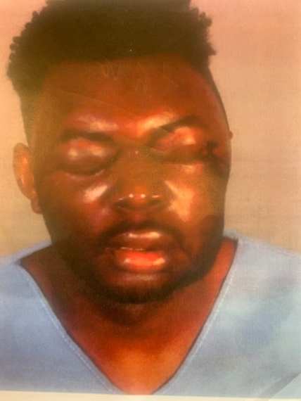 LA deputies accused of beating man until he lost sight in one eye, lawsuit alleges