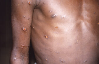 Monkeypox treatment has been available for years, just not for African nations that had the most cases and suffered with it the longest