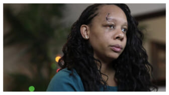 Two years after a rubber bullet fractured her eye socket, a protester is suing Fort Lauderdale and the police