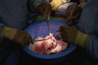 Pig hearts sewn into brain-dead people furthers research for saving humans with animal organs