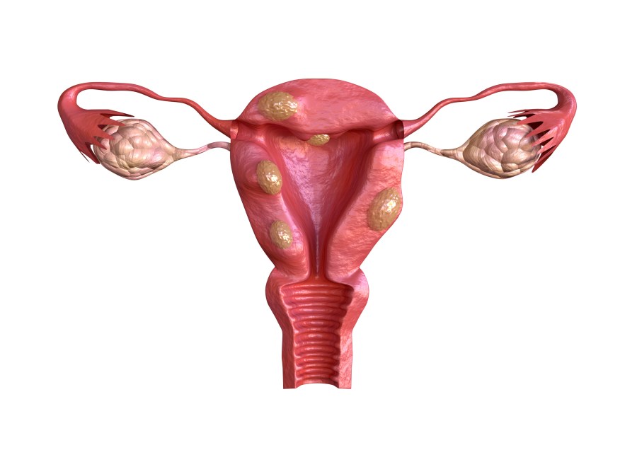Uterine Fibroids are benign solid tumors formed by muscle tissue. Its size can vary greatly and some cause large abdomen increase.
(Adobe Stock)