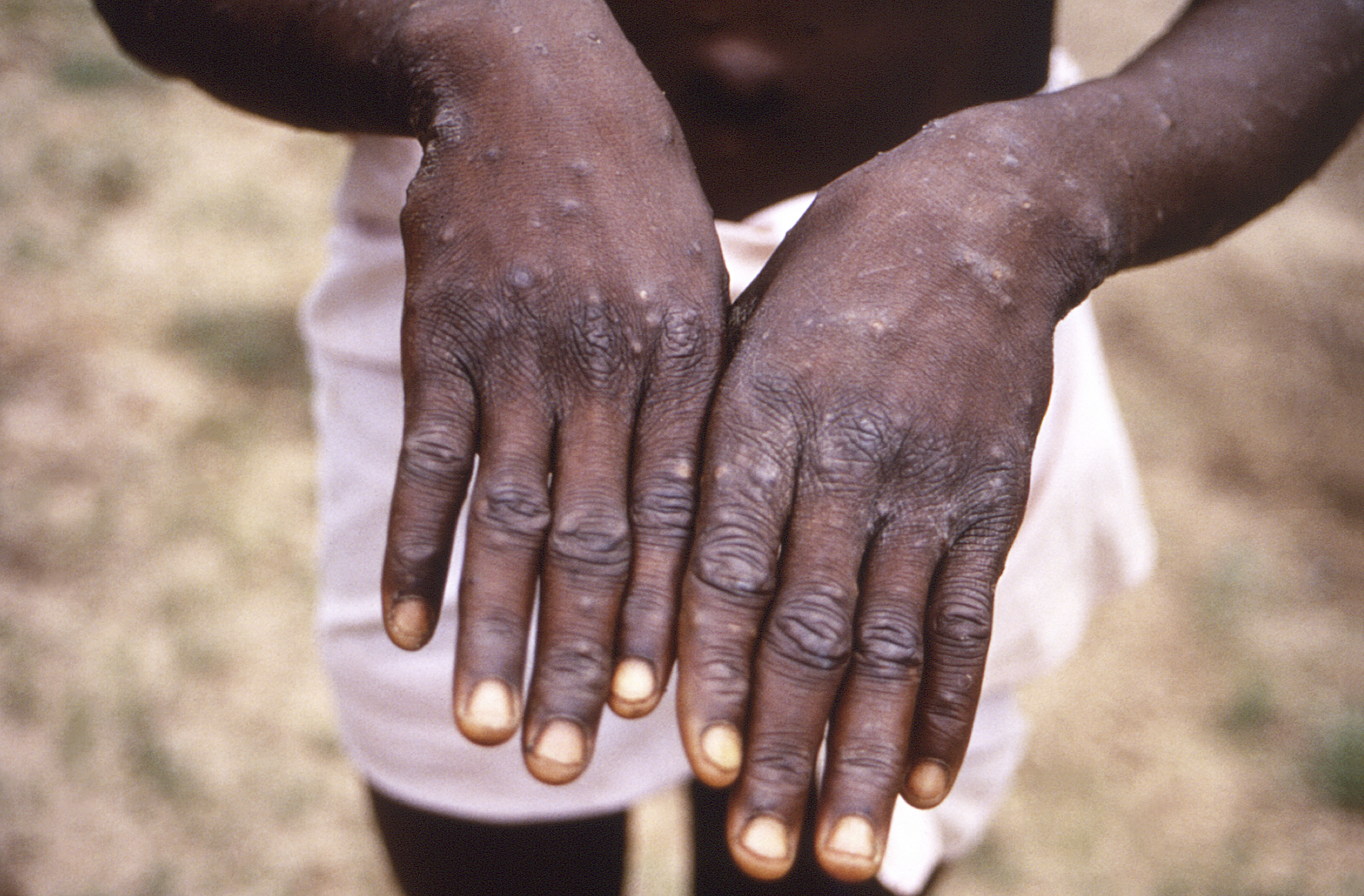 Congo mpox, theGrio.com