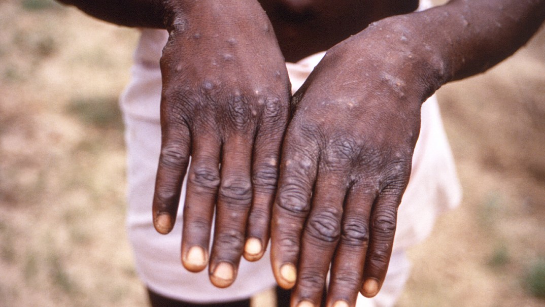 Congo mpox, theGrio.com