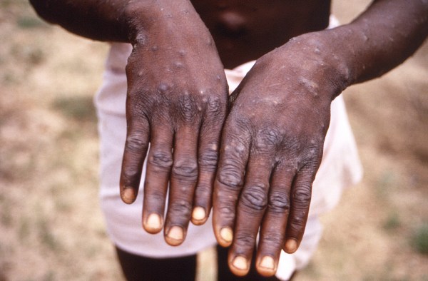 Stigma against gay men could worsen Congo’s biggest mpox outbreak, scientists warn