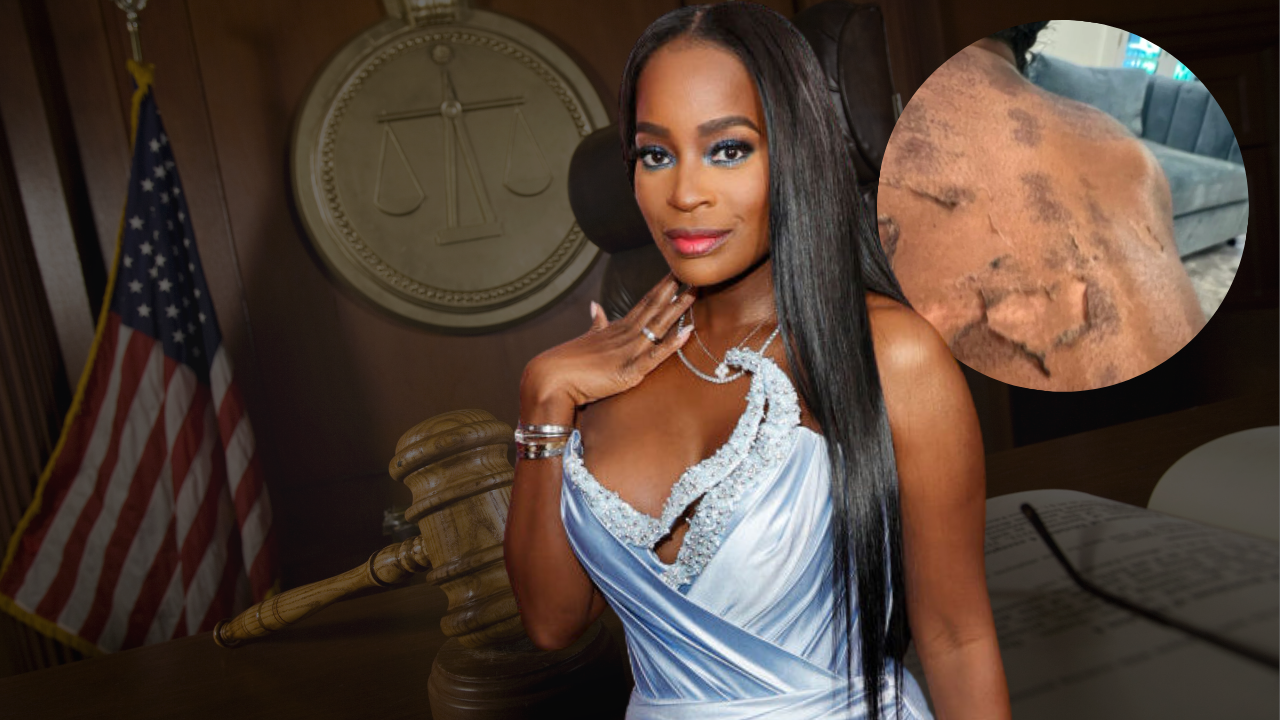RHOA Star Shamea Morton Sues Atlanta Doctor After Chemical Peel Allegedly Leaves Scars